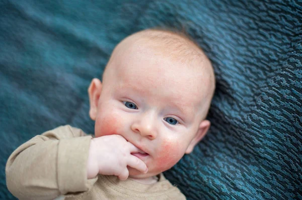 Bambino Con Manifestazioni Allergia Alimentare Sul Viso — Foto Stock