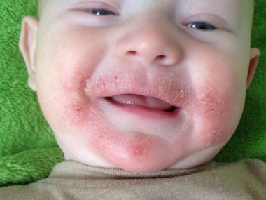 Gıda alerjileri ve çocuk portre yüzünde Atopik dermatit