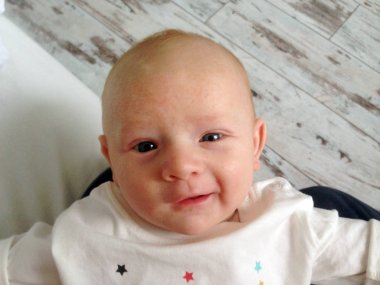 Gıda alerjileri ve çocuğun yüzünde Atopik dermatit