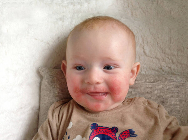Infant with signs of allergy on the face in a highchair