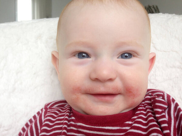 Infant with traces of allergy on the face