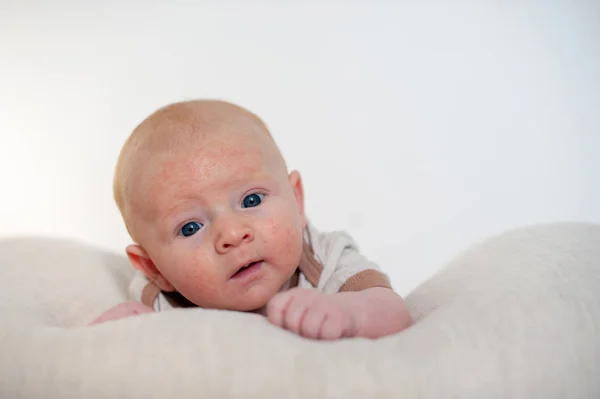 Allergien Neurodermitis Gesicht Eines Babys — Stockfoto