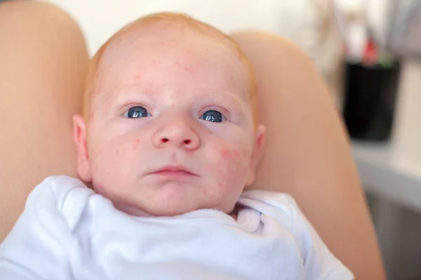 Spuren Einer Allergie Gesicht Eines Babys — Stockfoto