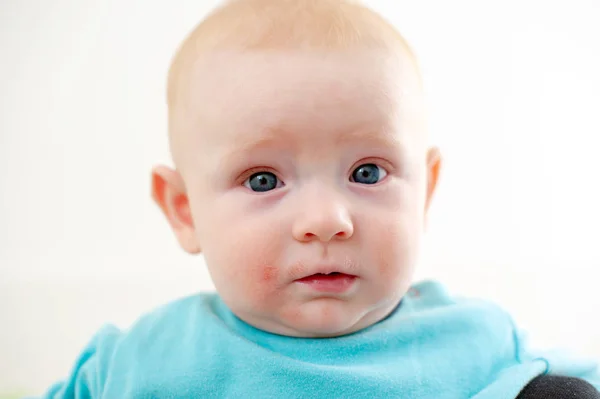Αλλεργίες Ατοπική Δερματίτιδα Πρώτης Όψεως Ένα Μωρό — Φωτογραφία Αρχείου