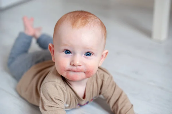 Allergia Pelyhesítés Sebek Atópiás Dermatitis Magában Baba — Stock Fotó