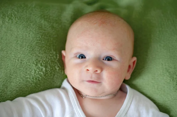 Allergien Neurodermitis Gesicht Eines Babys — Stockfoto