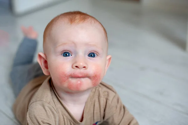 Tracce Diatesi Allergie Sulle Guance Del Bambino — Foto Stock