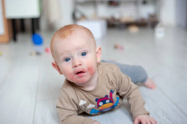 Traces Diathesis Allergies Baby Cheeks — Stock Photo, Image