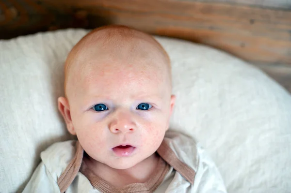 Allergies, atopic dermatitis on the face of a baby