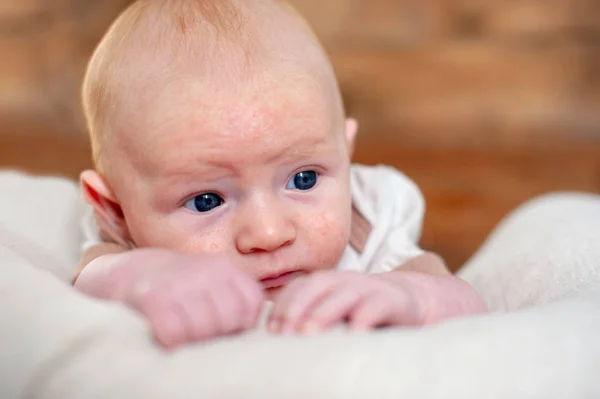 Allergia Atópiás Dermatitis Magában Baba — Stock Fotó