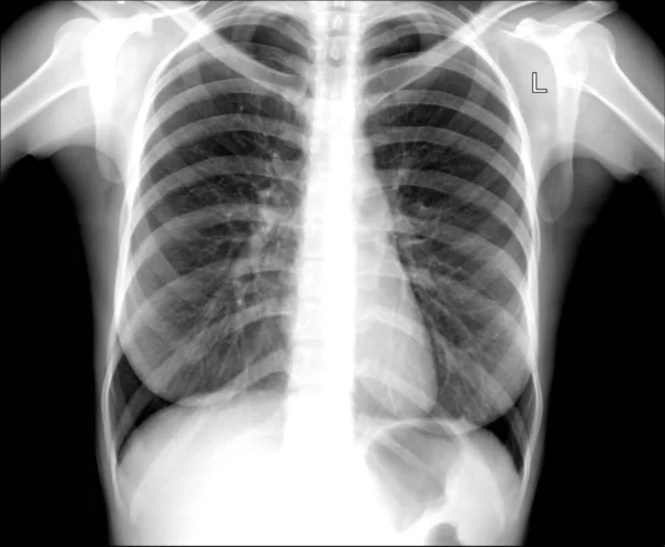 Röntgen Der Brust Lungenentzündungsprophylaxe — Stockfoto