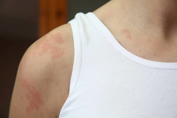 アレルギー性皮膚炎 — ストック写真