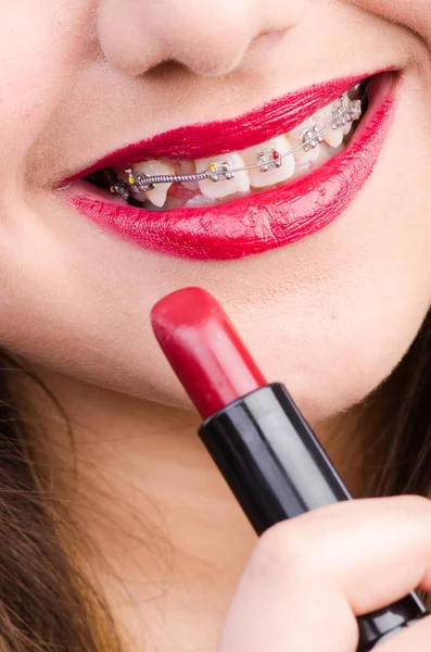 Mund mit Brackets und rotem Lippenstift — Stockfoto