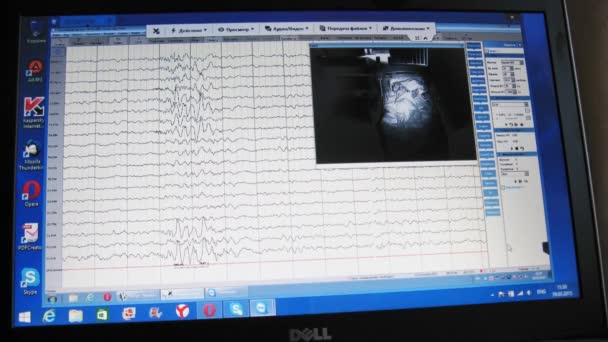 Na tela do computador é resultados do neuroscópio — Vídeo de Stock