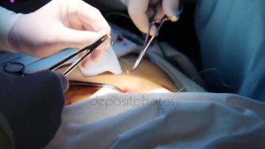 Hekimlerin endoskopi işlemi sonra gözyaşları kadar dikiş el görünümünü kapat