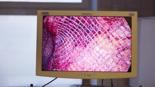 Bildschirm Mit Endoskopischer Chirurgie Mit Netzplastik Bauchorgan — Stockvideo