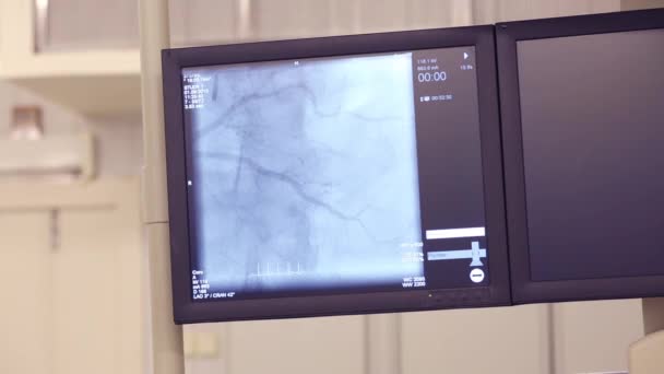 Εμφάνιση Των Angiograph Ακτίνων Κατά Διάρκεια Της Καρδιο Αγγειακού Εξέταση — Αρχείο Βίντεο