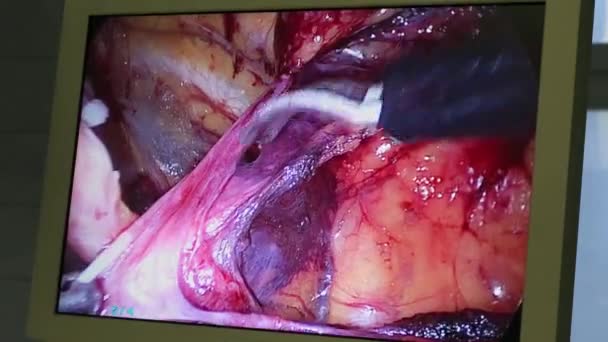 Affichage Montrant Une Chirurgie Endoscopique Dans Organe Abdominal — Video