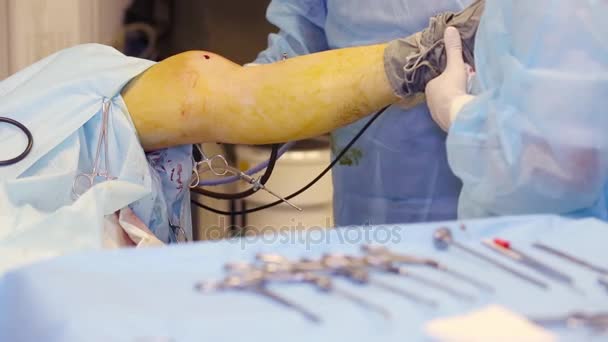 Médico Enfermeiro Mãos Durante Cirurgia Endoscópica Articulação Joelho — Vídeo de Stock