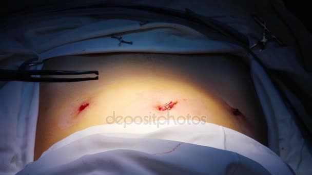 Menutup Pandangan Tangan Dokter Yang Memaksakan Klip Setelah Operasi Endoskopi — Stok Video