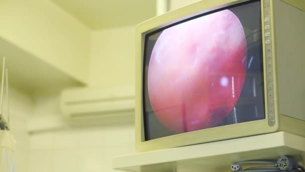 医院内镜手术中的膝关节显示 — 图库视频影像