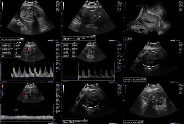 Ultrasonografi fetus resimleri — Stok fotoğraf