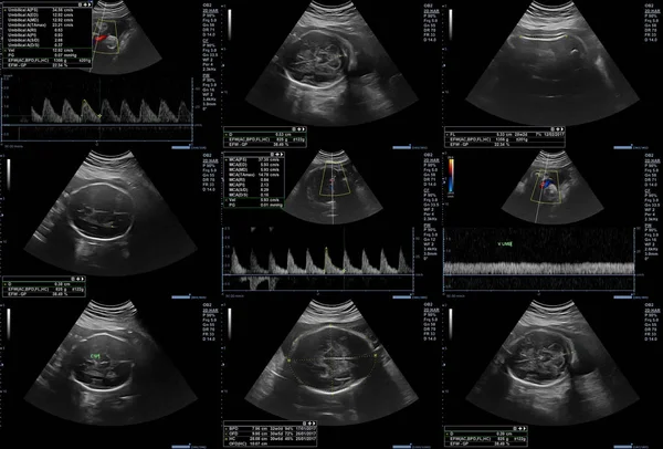 Ultrasonografi fetus resimleri — Stok fotoğraf