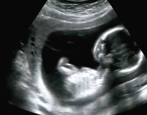 Geburtshilflicher Ultraschall Ultraschall-Echographie des ersten Monats — Stockfoto