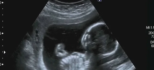 Análisis ultrasonográfico de un feto de cuarto mes —  Fotos de Stock