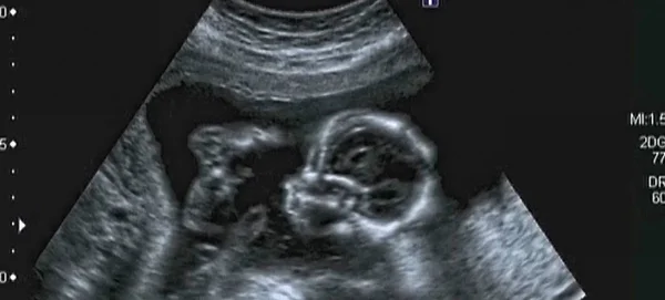 Ultrasonography Analysis of a 4th Month Fetus — Stock Photo, Image