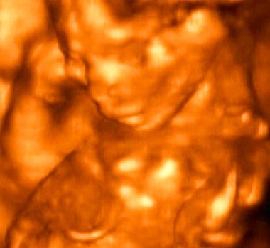 4 ayda cenin 3D Ultrasonografi analizleri