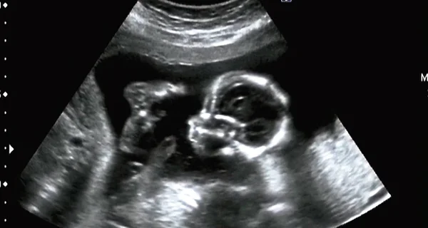 Ultraschalluntersuchung Eines Fetus Monat Italien — Stockfoto