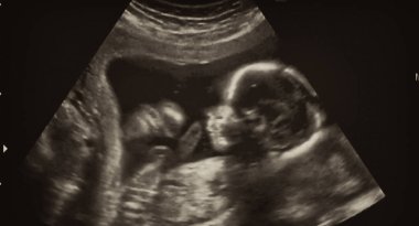 4. Fetüs 'ün Ultrasonografi Analizi, İtalya