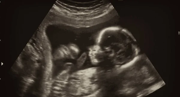 意大利第4个月胎儿的超声分析 — 图库照片