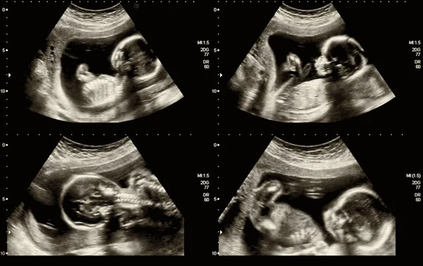 Medical images collage of ultrasound during woman pregnancy showing fetus in third month.