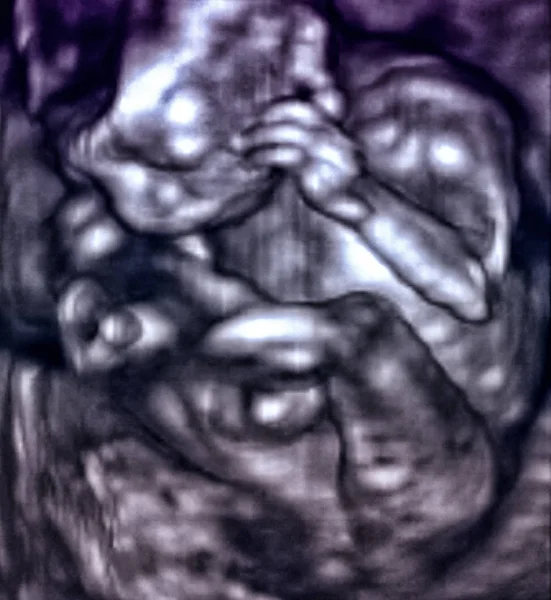 Bild Ultraschall Des Babys Mutterleib — Stockfoto