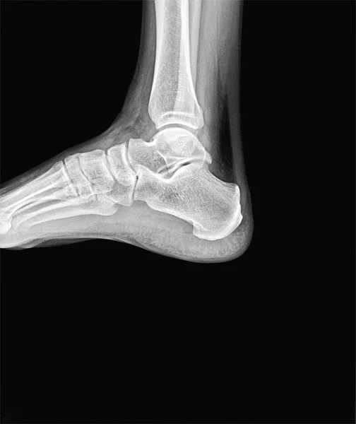 Man Right Ankle Ray Side Scan — Stock Photo, Image