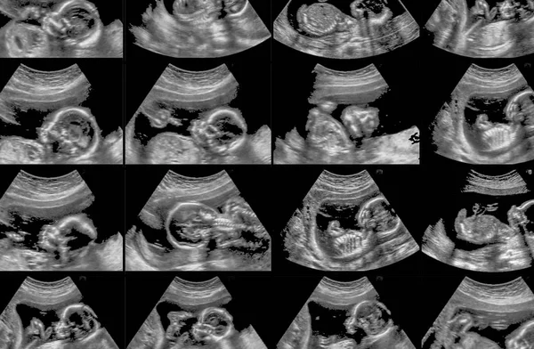 Collection Ultrasonography Fetus Scans — Stock Photo, Image