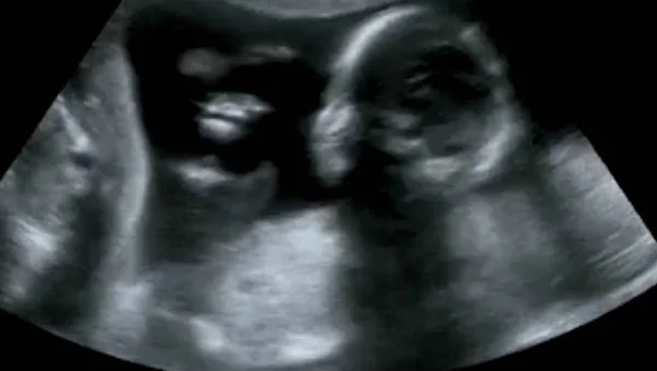 Porodnická Ultrazvuková Ultrazvuk Echografie Čtvrtého Měsíce Plodu — Stock fotografie