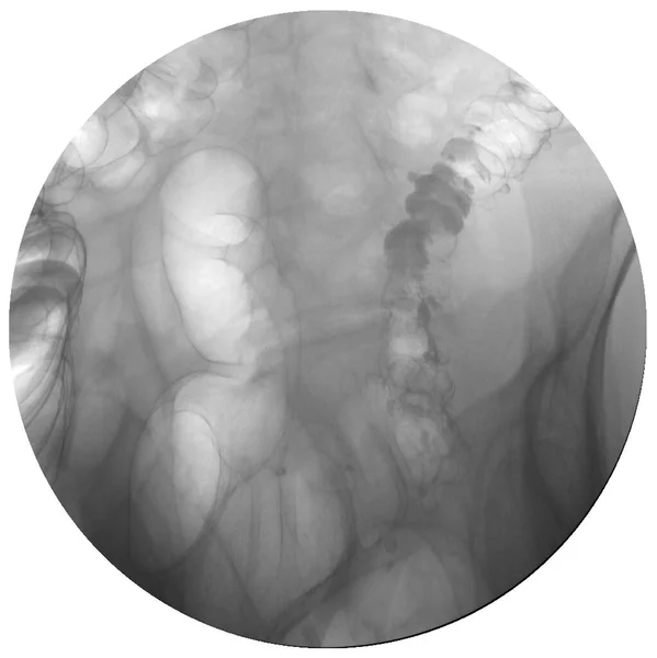 Bárium beöntés, kettős kontrasztos vizsgálat, colorectalis röntgen — Stock Fotó