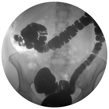 Barium enema image or x-ray image of large intestine or colon sh clipart