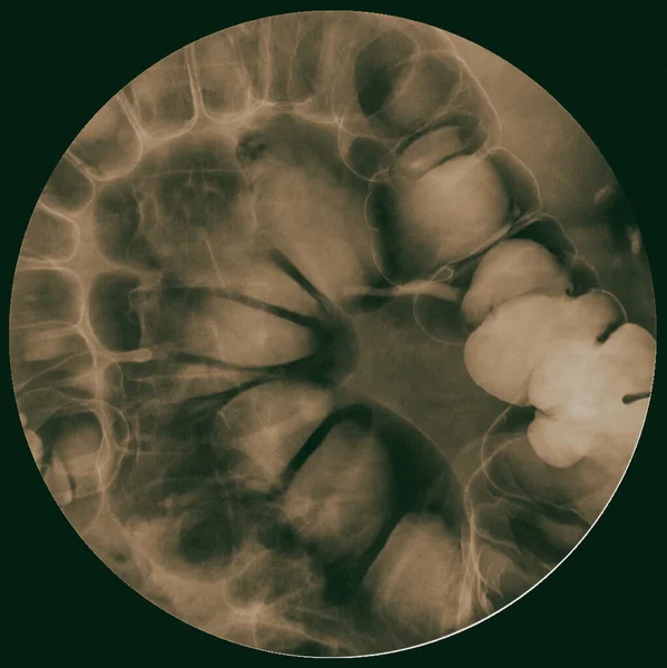 X-ray Barium klystýr vyšetření (nižší gastrointestinální) — Stock fotografie