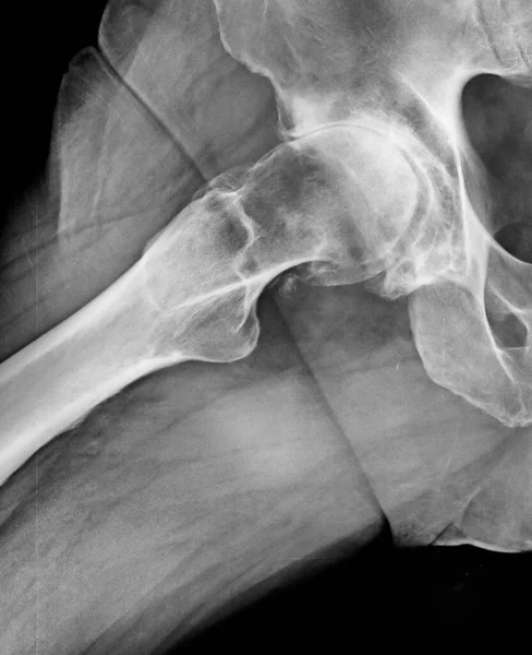 남자의 골반과 척추 의 X 선 사진 — 스톡 사진