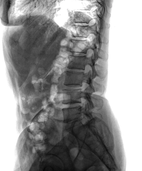 Diagnostic spinal X-ray film of a patient — Stock Photo, Image