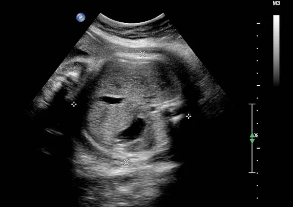 Echografie van de foetus in de derde maand van de zwangerschap — Stockfoto