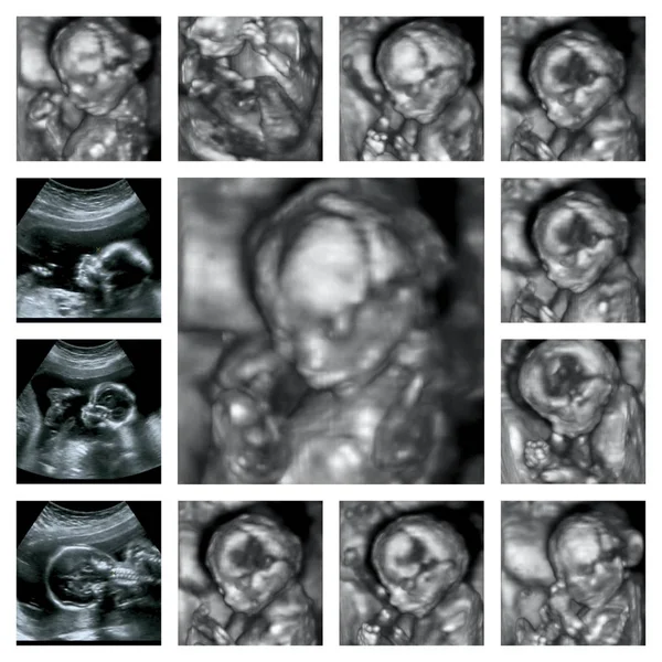 Collage av 3d Ultraljud av foster i fjärde månaden graviditeten — Stockfoto
