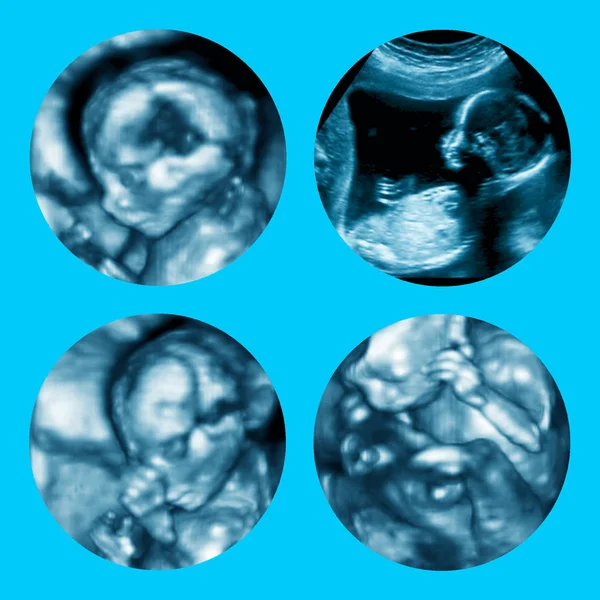 Collage of 3d Ultrasound of fetus in fourth month pregnancy — Stock Photo, Image