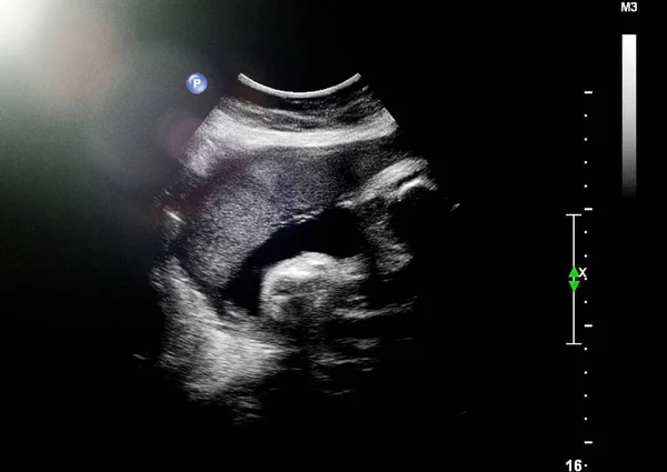 Ultrassom do feto no terceiro mês de gravidez — Fotografia de Stock
