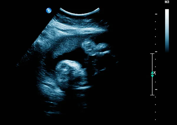 УЗИ плода на третьем месяце беременности — стоковое фото