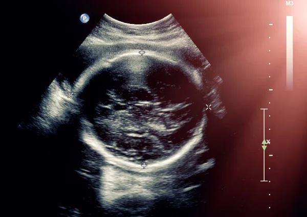 Échographie du fœtus pendant la grossesse du troisième mois — Photo